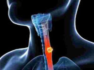 The dangerous effect of oesophagus cancer