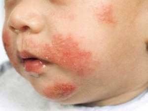 Atopic Dermatitis: Typical wheal-and-flare responses to skin scratch for various allergens