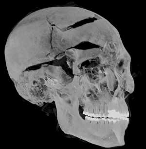 A computed tomography (CT) scan performed on the mummy of ancient Egyptian King Seqenenre Tao II - experts now think he was executed after being captured during battle. By - (Egyptian Ministry of Antiquities/AFP)