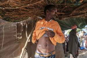 Dawud Kibret shows scars of where he was shot in the abdomen. He is keen to join a government-organized militia. By EDUARDO SOTERAS (AFP)