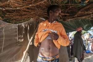 Dawud Kibret shows scars from where he was hit in the abdomen.  He wants to join a militia organized by the government.  By EDUARDO SOTERAS (AFP)