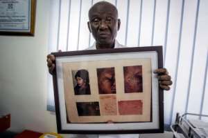 Risk: Edmund Delle, a dermatologist at the Rabito Clinic in Accra, holds up a picture of a woman with ochronosis -- discoloration caused by long-term application of hydroquinone to lighten the skin.  By CRISTINA ALDEHUELA (AFP)