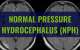 Unlocking Normal Pressure Hydrocephalus: Understanding, Diagnosis and Treatment Options