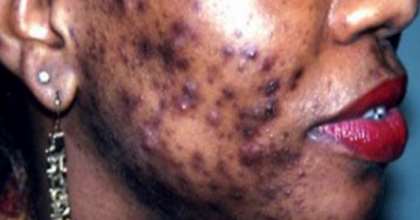 The Identity Crisis Of Skin Bleaching